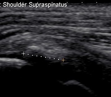 Ultrasound Calcific Tendonitis